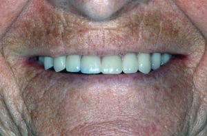 After dental procedure - performed at Trahos Dental in Fredericksburg, VA