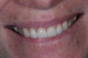 After dental procedure - performed at Trahos Dental in Fredericksburg, VA