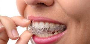 Invisalign offered at Trahos Dental in Fredericksburg, VA