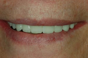 After the procedure - Norman Trahos - Dentist Fredericksburg, Virginia