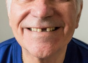 404 - tooth missing - Trahos Dental - Fredericksburg, VA